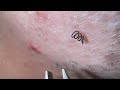 Plucking facial hair & ingrown hair 1359 頬髭抜き(埋没毛あり)