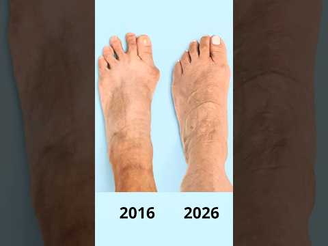 10 AÑOS DESPUÉS MIRA COMO ESTA MI PIE