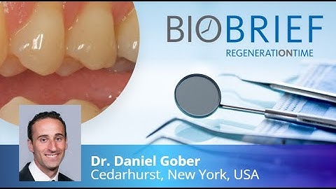 Geistlich Mucograft® for the treatment of multiple adjacent recession defects