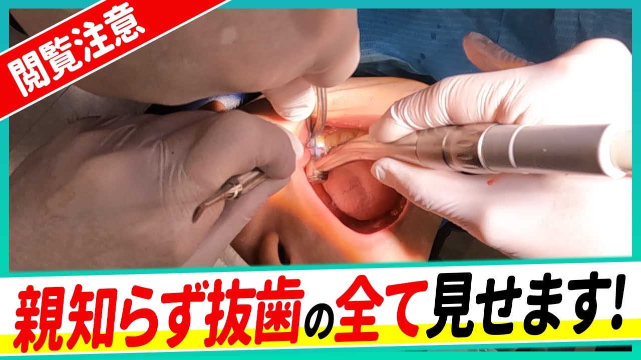 親知らず 抜歯 手術