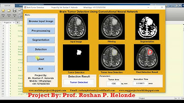 Matlab Project on Brain Tumor Detection Using Convolutional Neural Network CNN