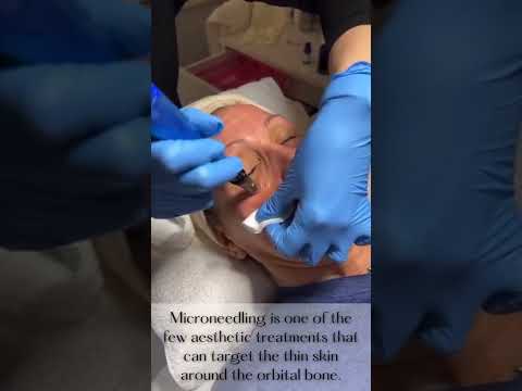 Full Face Microneedling