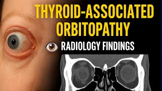 Thyroid-Associated Orbitopathy: Radiology Findings 👁️