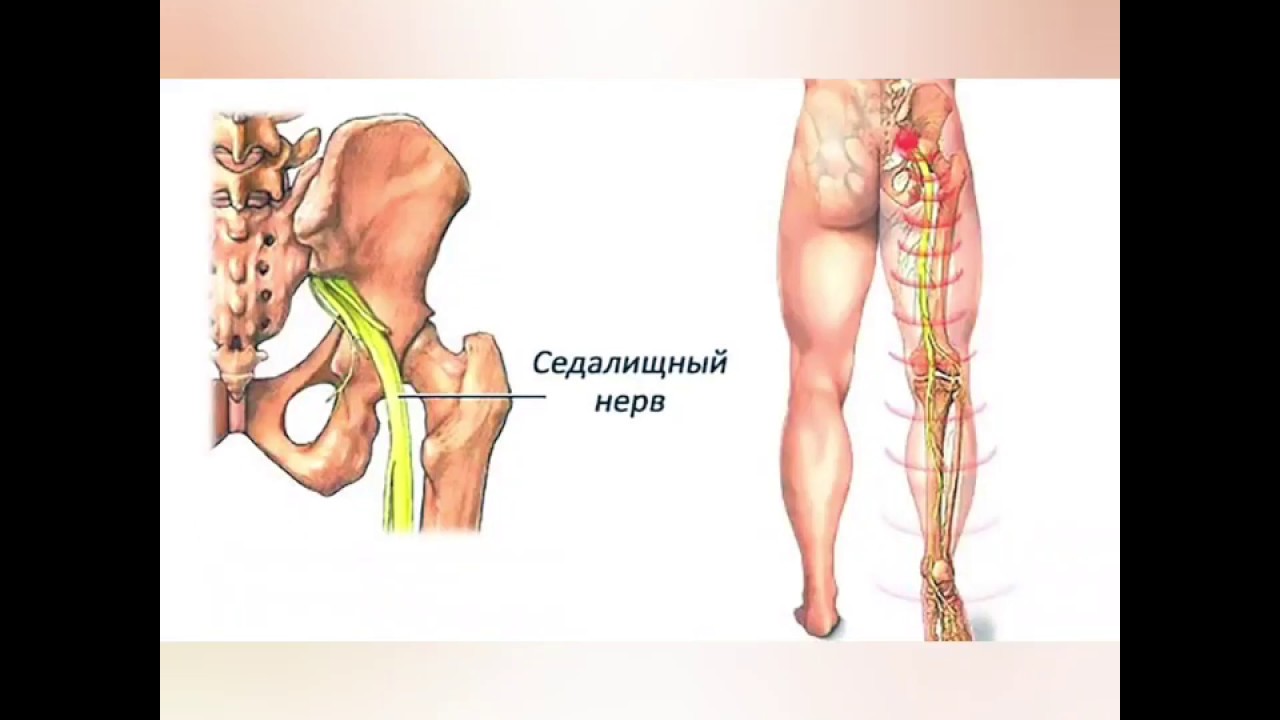 Заземление седалищный нерв лечение и симптомы с фото