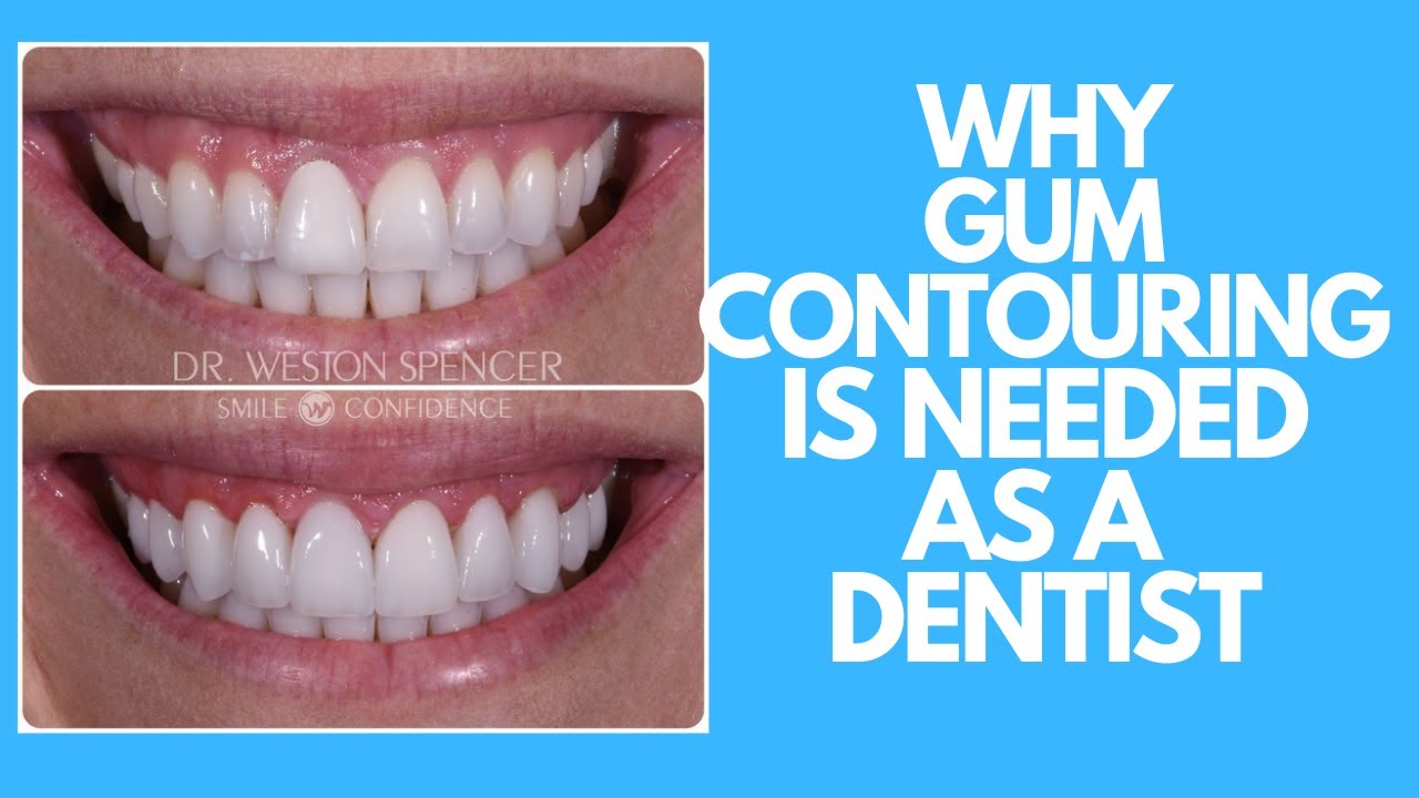 Why Gum Contouring is Needed As a Dentist! YouTube