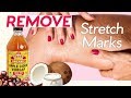 How to Get Rid of Stretch Marks! 7 Natural Ways + 4 Pressure Points