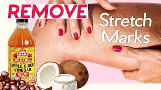 How to Get Rid of Stretch Marks! 7 Natural Ways + 4 Pressure Points screenshot 5