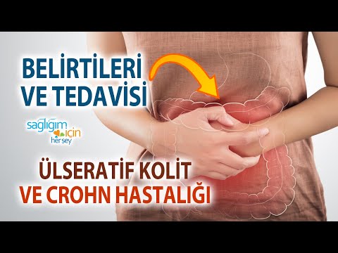 Ülseratif Kolitin ve Crohn Hastalığının Belirtileri ve Tedavisi