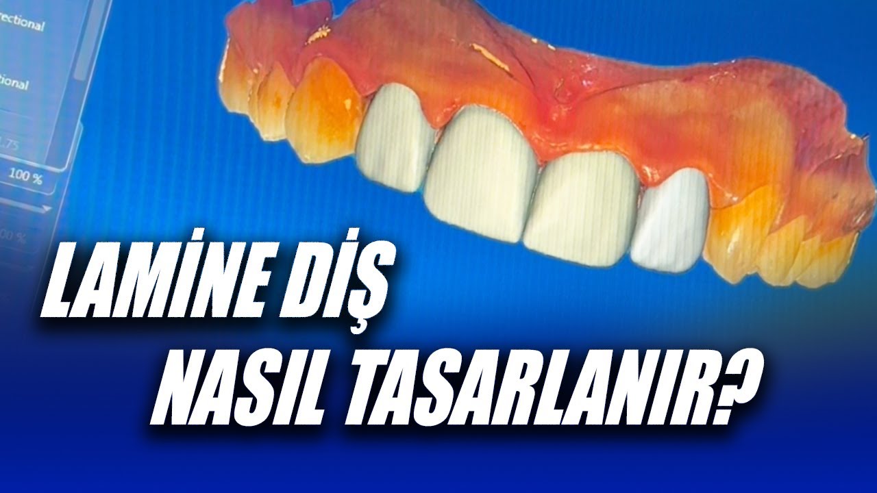 Lamine Diş Tasarımı Nasıl Yapılır? Dijital Diş Tasarımı, Gülüş Tasarımı Dijitalde Nasıl Yapılır?