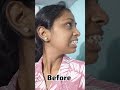 😬🦷 Braces Transformation Before and After || Pain paid off 🥹 #ytshorts #bracestransformation
