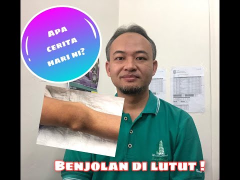 Video: Varus Lutut: Gejala, Punca, Pembedahan, Dan Rawatan