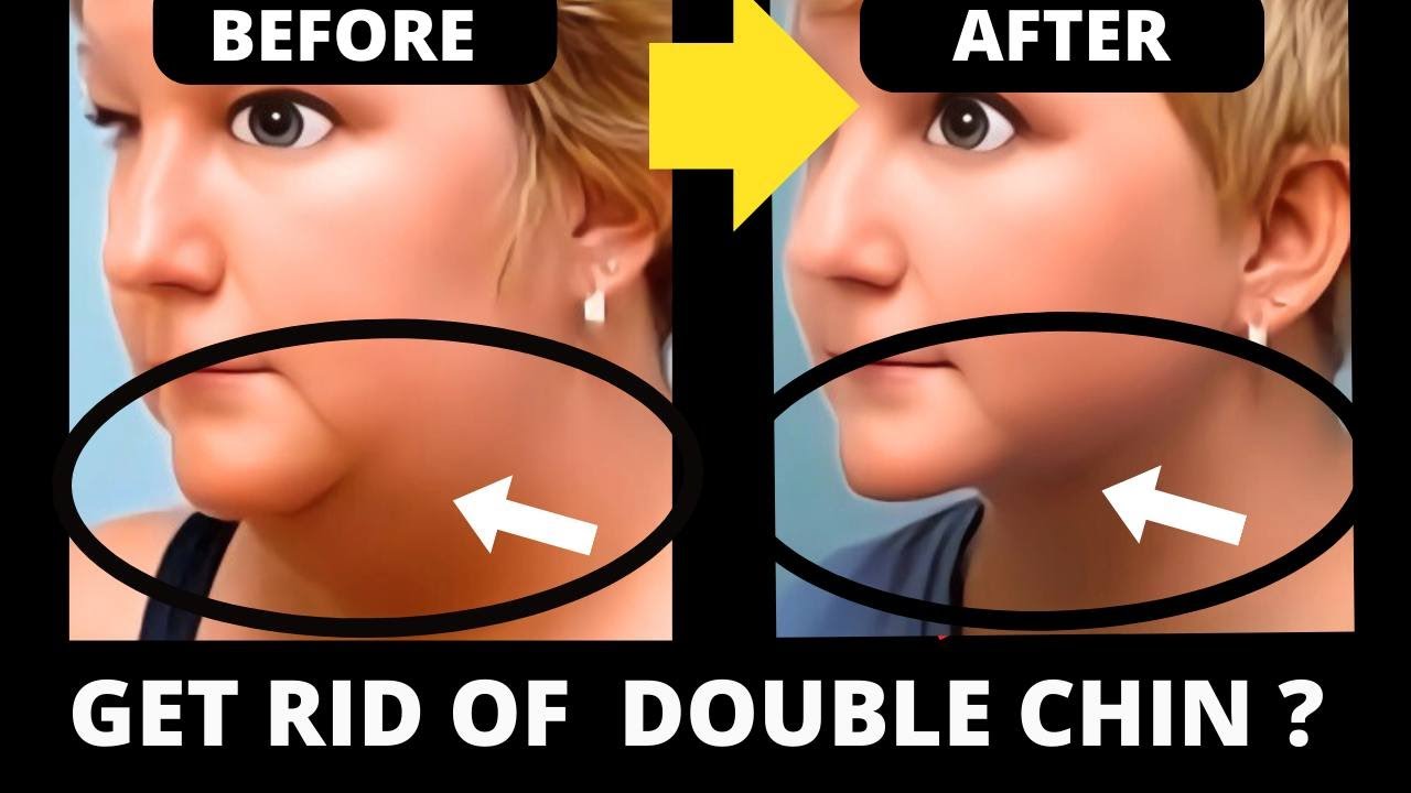 How To Get Rid Of Doubke Chin