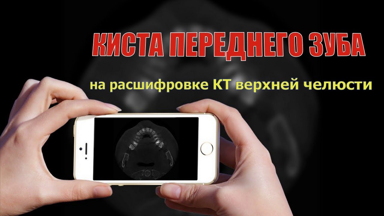 КИСТА ПЕРЕДНЕГО ЗУБА и признаки поверхностного КАРИЕСА при ЧТЕНИИ КТ ...