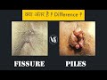 Piles vs fissure  difference 