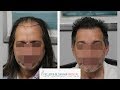 6 Month Hair Transplant Results: What to Expect? | Feller & Bloxham Medical | NY, NYC, Long Island