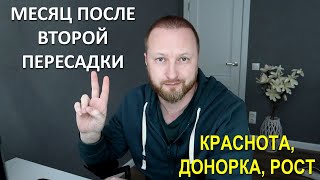 1 МЕСЯЦ ПОСЛЕ ВТОРОЙ ПЕРЕСАДКИ ВОЛОС | FUE vs DHI |