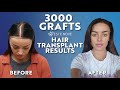 Female hair transplant in turkey  rachels new hair  before and after
