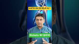 Child Weakness Rickets Remedy Rickets Ke Causes Symptoms And Treatment