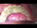 Houston Cosmetic Dentist...Worst Tartar I have seen! Watch how we remove it...