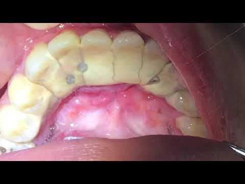 Houston Cosmetic Dentist…Worst Tartar I have seen! Watch how we remove it…