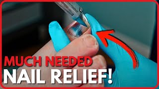 Toenail Trim & Cleanup Watch A Foot Transformation From Start To Finish