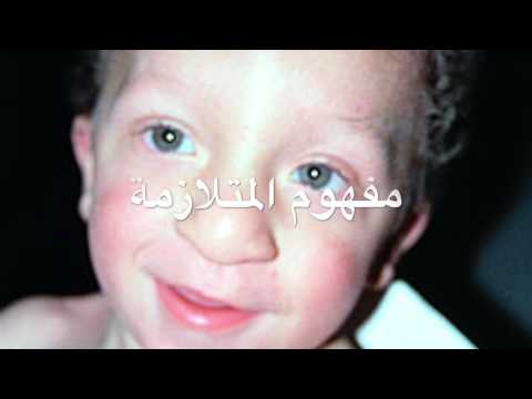 متلازمة نونان Noonan syndrome