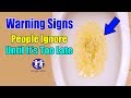 (Foamy urine!! Beware of its dangers..!)  People Ignore  Until It’s Too Late