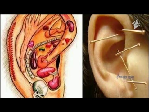 რა გართულებები შეიძლება მოყვეს ყურის პირსინგს - სპეციალისტის რეკომენდაცია