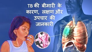 Tuberculosis (TB) के कारण, लक्षण और उपचार – Tuberculosis Causes, Symptoms & Treatment in Hindi