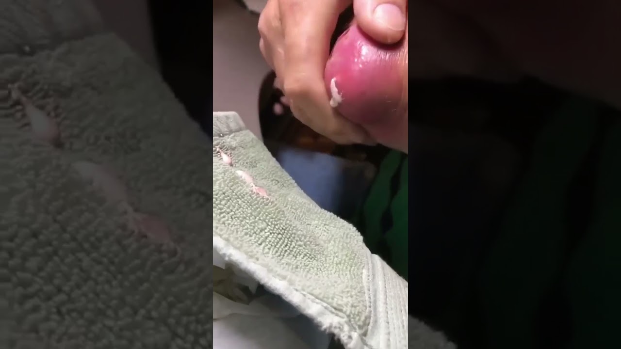 DISGUSTING ELBOW CYST POP