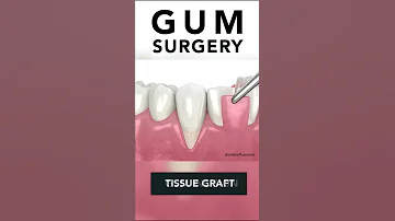 Receding Gums Surgery 