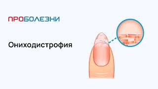 Ониходистрофия