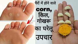 पैरों में होने वाले corn गोखरू, किल, 5 दिन में जड़ से मिट जाएंगे #corn #kill #gokharu