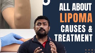 All about Lipoma - Causes & Treatment !!