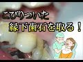 見えない怖い歯茎の下歯石！【dental calculus】