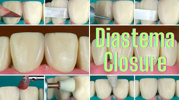 Midline Diastema Closure Photo Series Tutorial