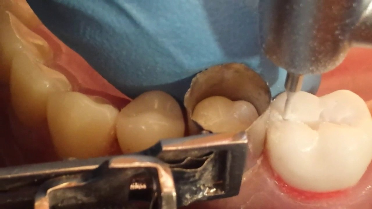 6- حفر رحى أولى سفلية صنف ثاني class II MOD