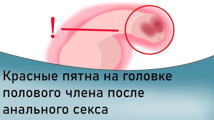 Зуд после полового акта Зуд после полового акта