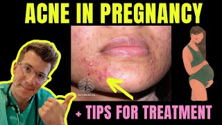 Doctor discusses ACNE IN PREGNANCY - top tips for HOME MANAGEMENT PLUS TREATMENT and things to AVOID