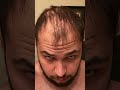 I Have A Hair Loss Confession #balding #baldcafe #Bald