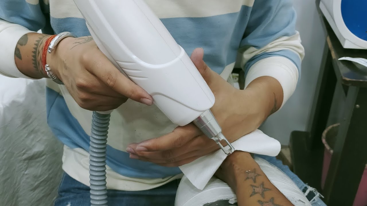 Tattoo removal and laser treatment