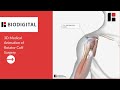 3d medical animation of a rotator cuff surgery