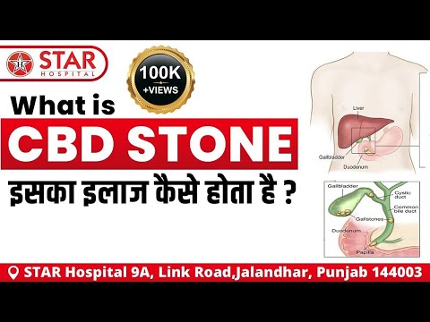 CBD Stone Treatment, in Hindi, ERCP surgery, ERCP Laparoscopic Surgery, Operation, पथरी का इलाज