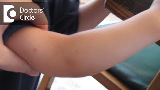 Presentation of Molluscum Contagiosum in kids - Dr. Varsha Saxena Presentation of Molluscum Contagiosum in kids - Dr. Varsha Saxena