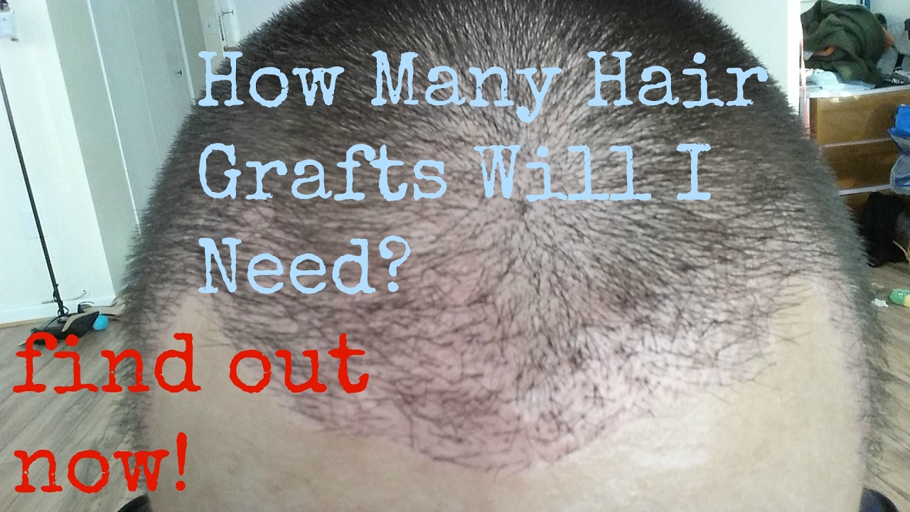 How Many Hair Grafts Do I Need For Hair Transplant? Hair Transplant Before  and After - YouTube
