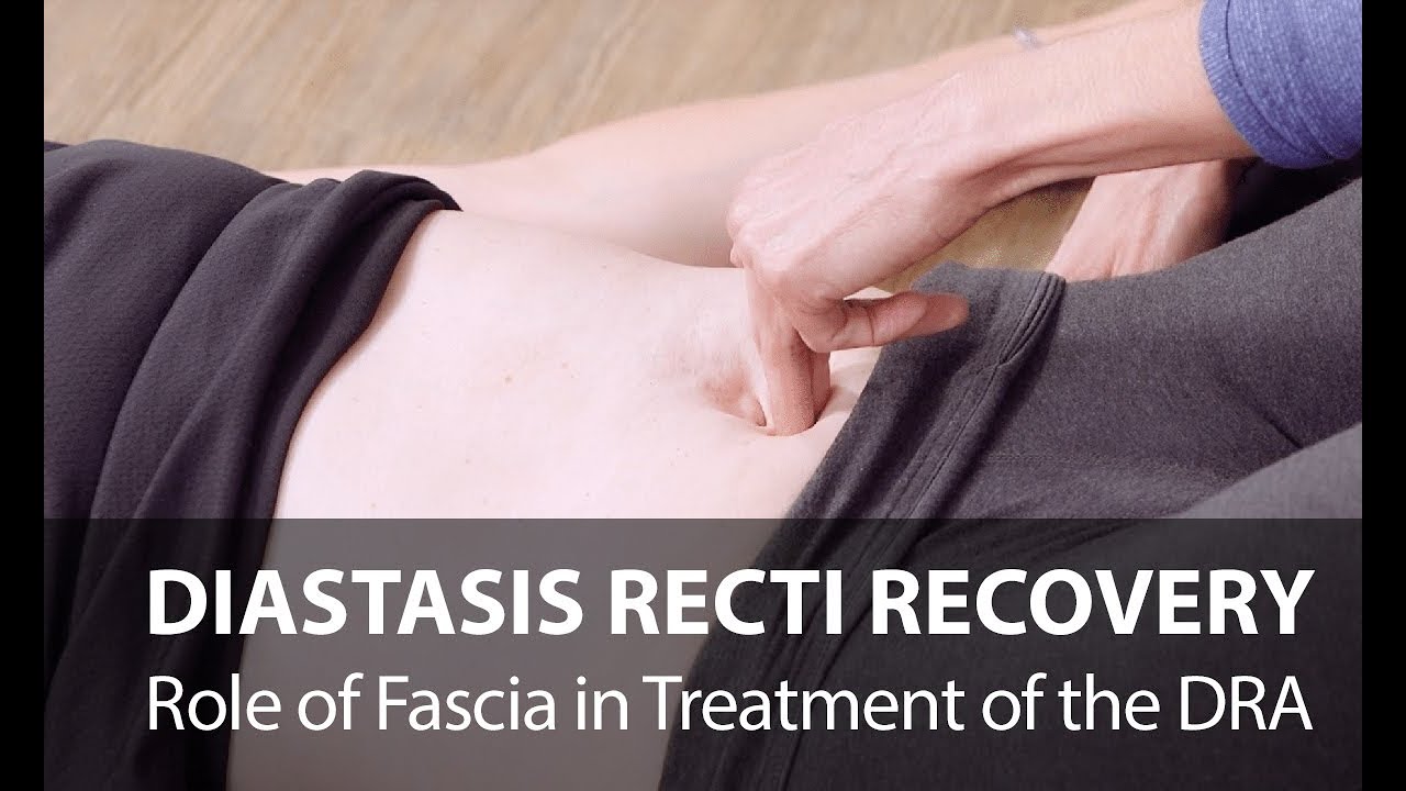 How Can You Start to Treat Diastasis Recti Yourself?