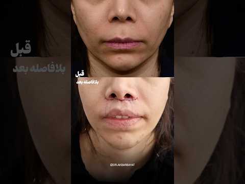 قبل و بعد از جراحی لیفت سانترال لب دکتر اکبر بیات