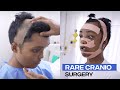 Incredible craniofacial transformation witnessing a rare surgical case