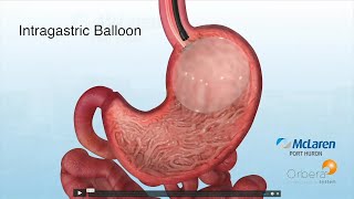 Bariatric surgery - weight loss options for obesity at mclaren port
huron, part 4
