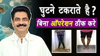 How to treat knock knee and bow leg | Treat knock knee without surgery| टेढ़े पैर को सीधा कैसे करें?